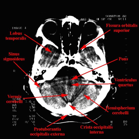 tomografia komputerowa głowy - 03.jpg